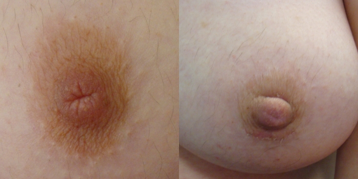 Correction of inverted nipples